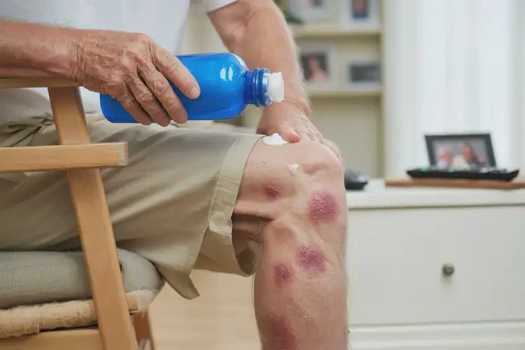 老年人小腿上容易起濕疹能靠自己自愈嗎(圖2)