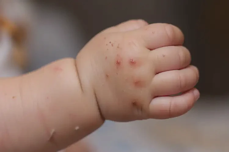 寶寶手上出現(xiàn)濕疹可以徹底自愈嗎(圖4)
