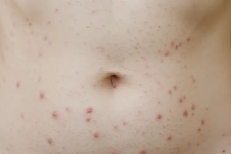 女生肚子上偶尔长湿疹不管它会自己痊愈吗(图4)