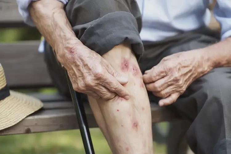 老年人小腿上出現(xiàn)濕疹不管它會自己自愈嗎(圖4)