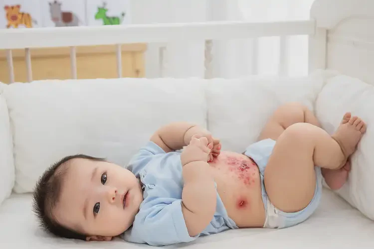 幼兒肚子經(jīng)常起濕疹能不能徹底自愈(圖4)