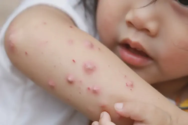 少兒手臂上出濕疹不管它會(huì)自己好嗎(圖4)