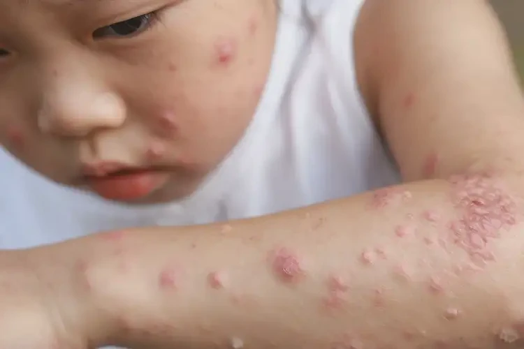 小兒全身長(zhǎng)濕疹不管它會(huì)自己痊愈嗎(圖4)