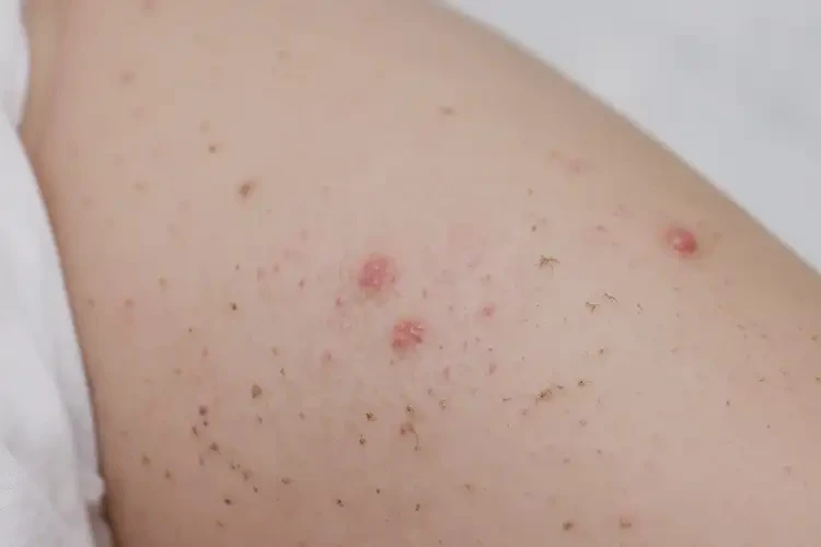 嬰幼兒大腿起濕疹不管它會(huì)自己好嗎(圖3)