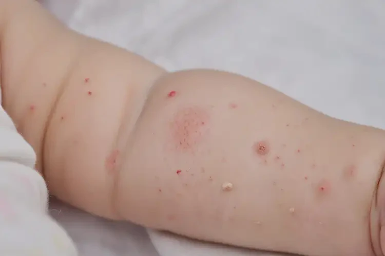 宝宝手臂上起湿疹能彻底自愈吗(图4)