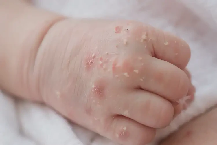 新生兒手上長濕疹不管它會自己好嗎(圖4)