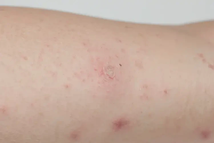 儿童手臂出现湿疹能彻底自愈吗(图4)