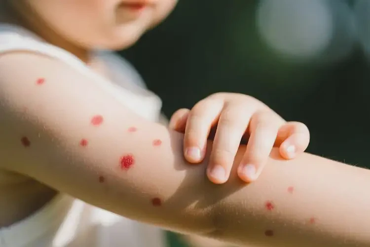 少兒手臂上偶爾長濕疹不管它會自己好嗎(圖4)