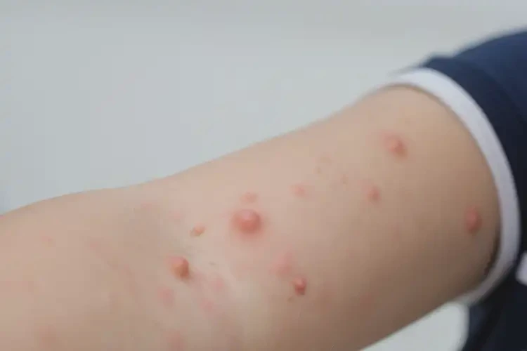 小學(xué)生手臂偶爾起濕疹可不可以徹底自愈(圖4)