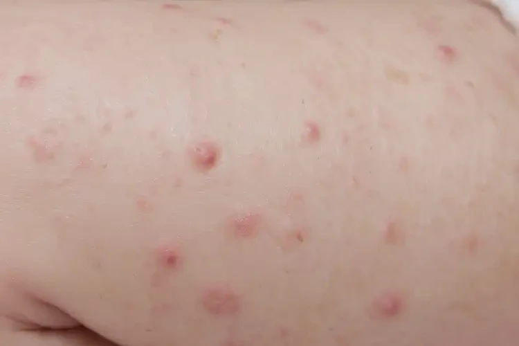 嬰兒小腿上長(zhǎng)濕疹能靠自己自愈嗎(圖4)