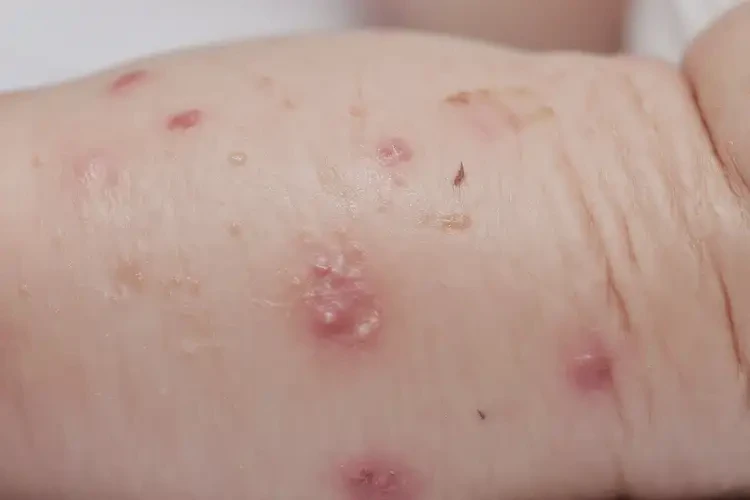 嬰兒小腿起濕疹不管它會(huì)自己自愈嗎(圖4)