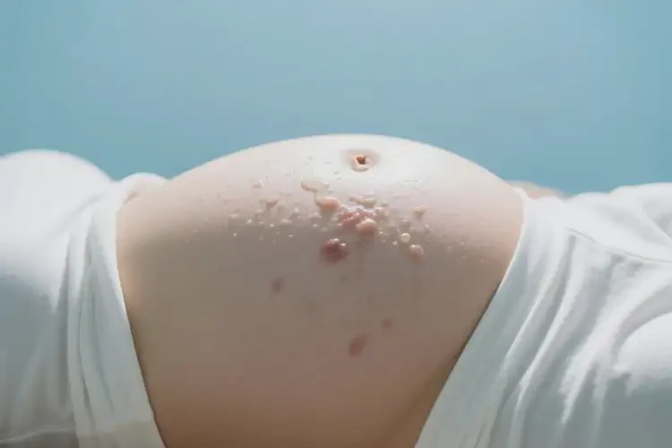 孕妇肚子出湿疹不管它会自己好吗(图2)