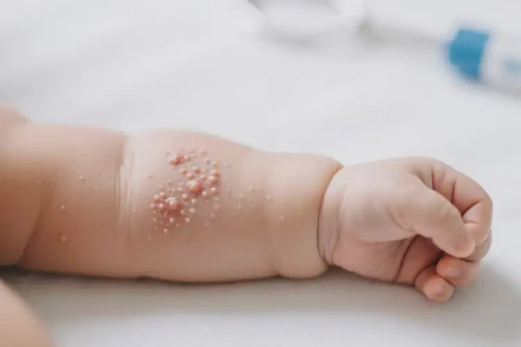 嬰幼兒手臂上出濕疹不管它會(huì)自己好嗎(圖1)