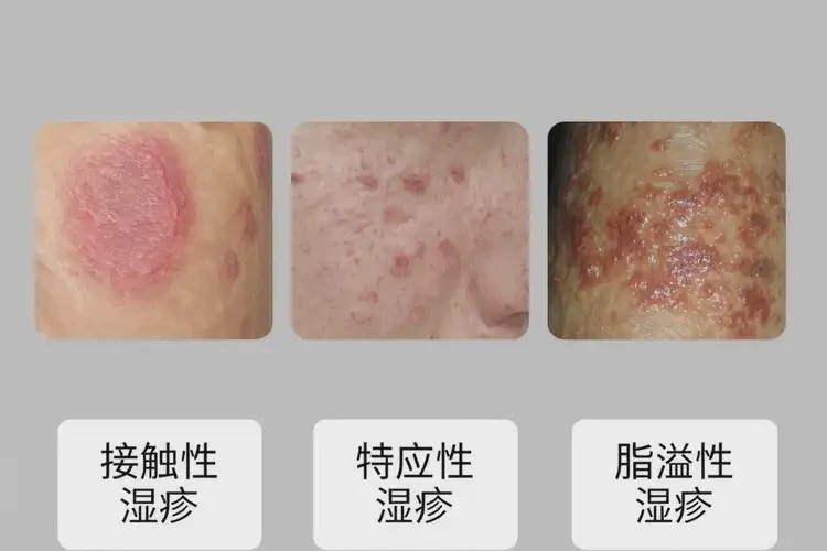 男性小腿上起濕疹不管它會(huì)自己好嗎(圖1)