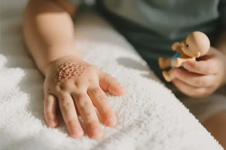 小孩手上容易長濕疹不管它會自己自愈嗎(圖1)