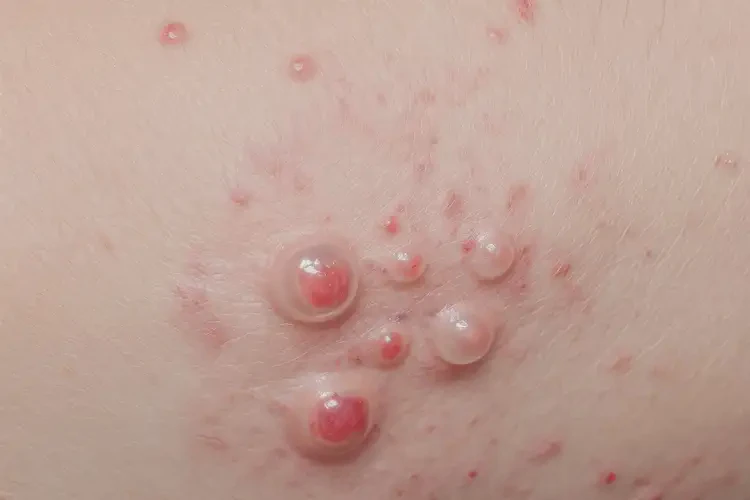 男人肛周偶爾長濕疹能徹底自愈嗎(圖4)