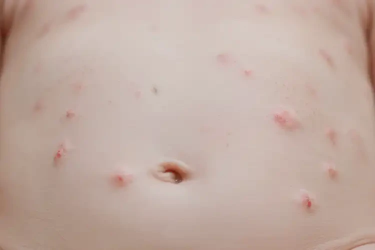 新生兒肚子出現(xiàn)濕疹可不可以徹底自愈(圖4)