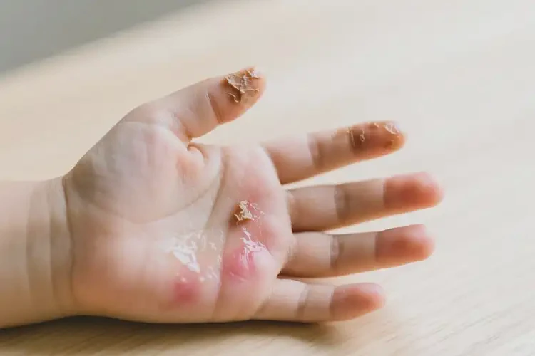 小兒手上偶爾起濕疹可以徹底自愈嗎(圖2)