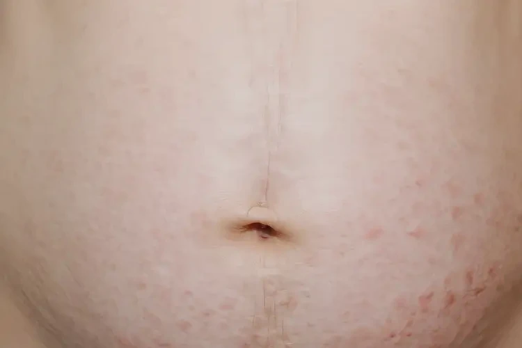 產(chǎn)婦肚子上起濕疹能靠自己自愈嗎(圖4)