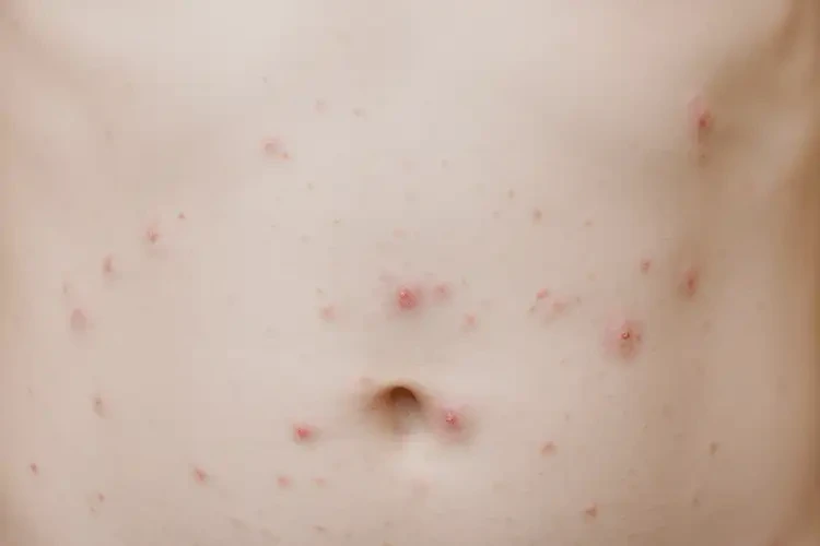 小學(xué)生肚子上長(zhǎng)濕疹不管它會(huì)自己痊愈嗎(圖4)