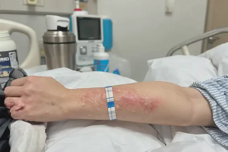 產婦手臂上長濕疹能徹底自愈嗎(圖4)