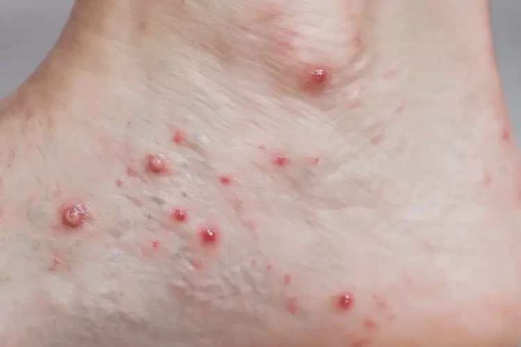 女生腳上出濕疹能徹底自愈嗎(圖4)