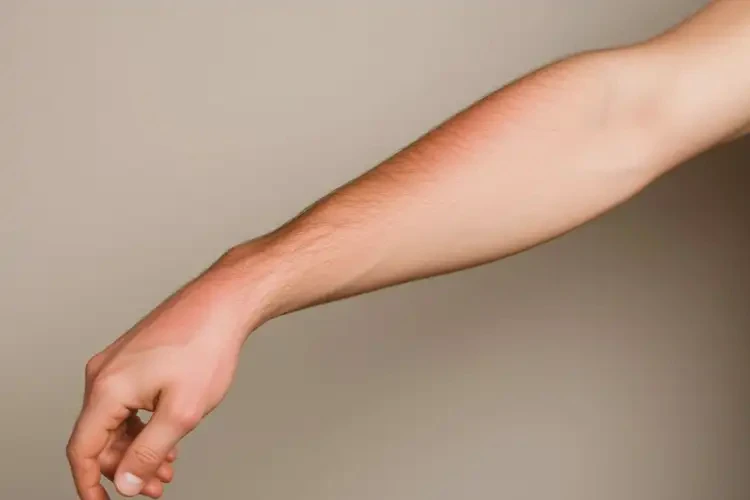 男性手臂出現(xiàn)濕疹不管它會(huì)自己痊愈嗎(圖4)