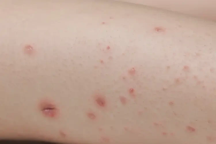 小學生大腿上偶爾起濕疹不管它會自己自愈嗎(圖4)