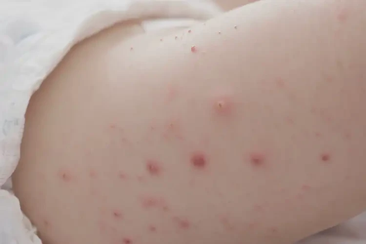 小兒屁股長濕疹能靠自己自愈嗎(圖4)