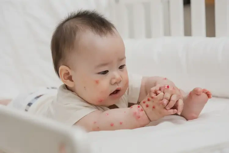 寶寶四肢偶爾長濕疹不管它會自己痊愈嗎(圖3)