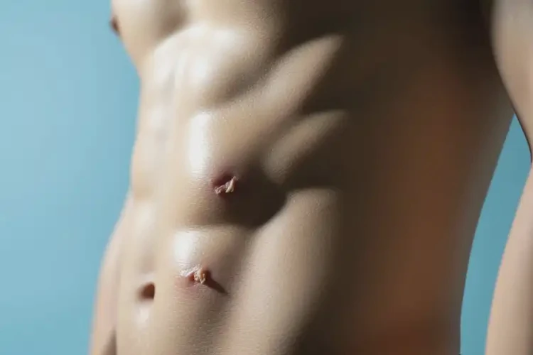 男性肚子上出濕疹能夠徹底治愈嗎(圖2)