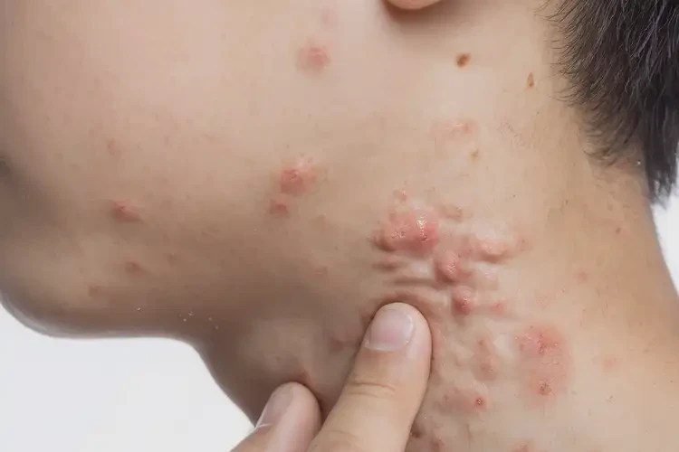 青少年脖子經(jīng)常起濕疹能夠徹底治愈嗎(圖4)