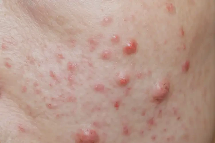 小學(xué)生肚子上長(zhǎng)濕疹不管它會(huì)自己痊愈嗎(圖3)