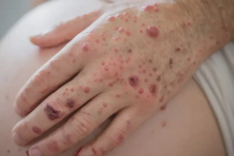 產(chǎn)婦手上出現(xiàn)濕疹可以徹底自愈嗎(圖4)