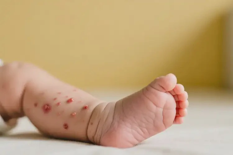 嬰幼兒小腿上長濕疹不管它會(huì)自己痊愈嗎(圖2)