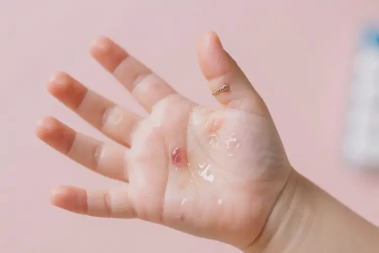 孩子手上出現(xiàn)濕疹可以徹底自愈嗎(圖2)