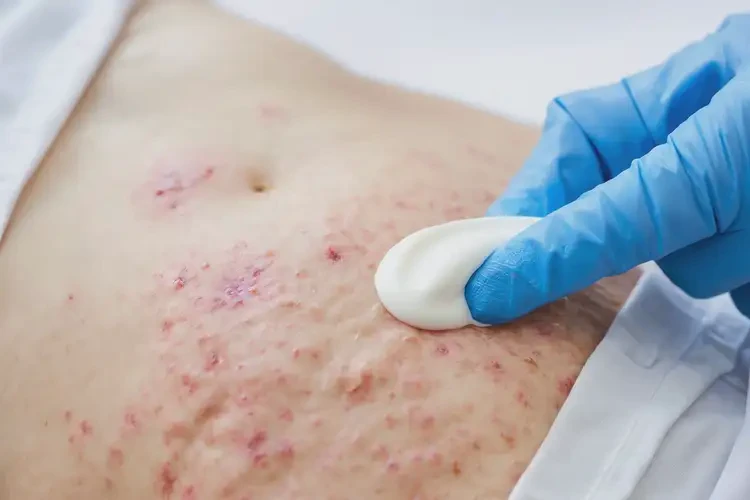 老人肚子容易起濕疹能夠徹底治愈嗎(圖3)