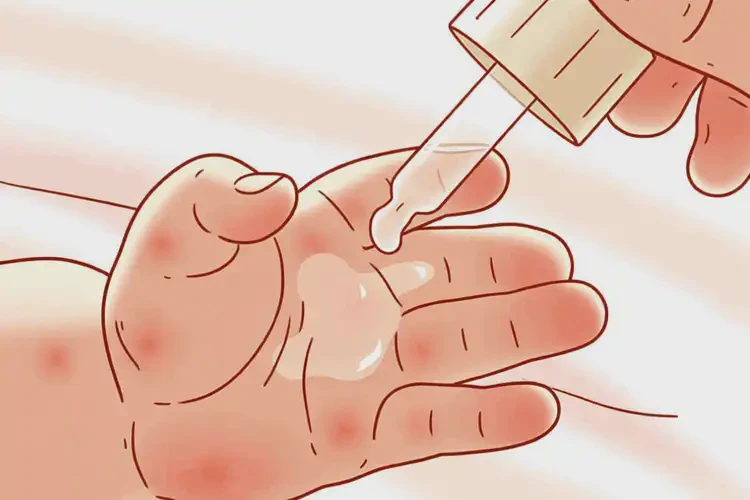 小兒四肢容易長(zhǎng)濕疹不管它會(huì)自己好嗎(圖4)