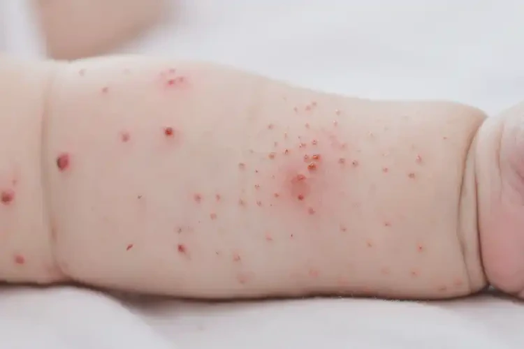 嬰兒手臂起濕疹可以徹底自愈嗎(圖4)