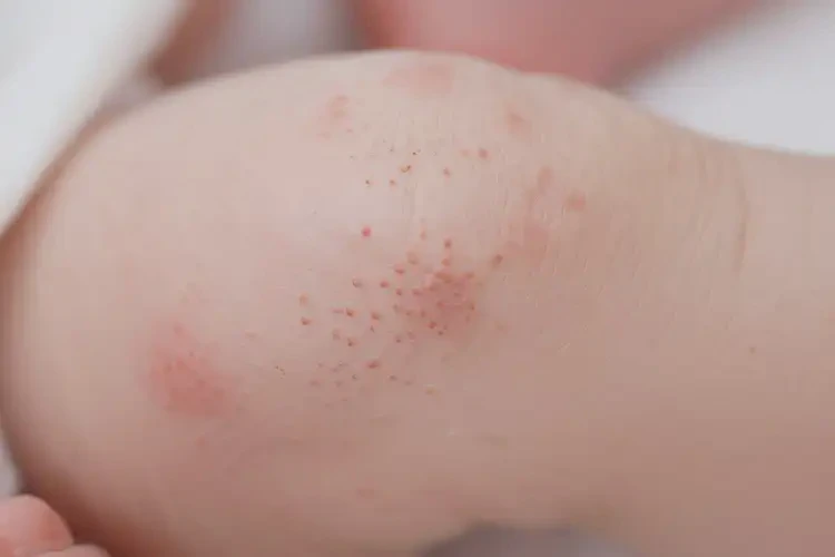 新生儿小腿上出湿疹可不可以彻底自愈(图4)