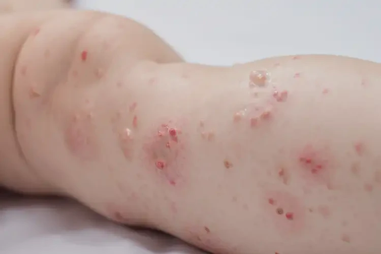 嬰幼兒大腿出現(xiàn)濕疹不管它會自己痊愈嗎(圖4)