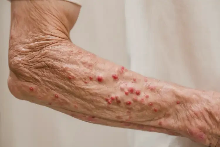 老年人手臂起濕疹不管它會(huì)自己自愈嗎(圖4)