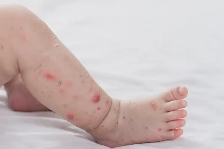 嬰兒小腿上長(zhǎng)濕疹能靠自己自愈嗎(圖2)