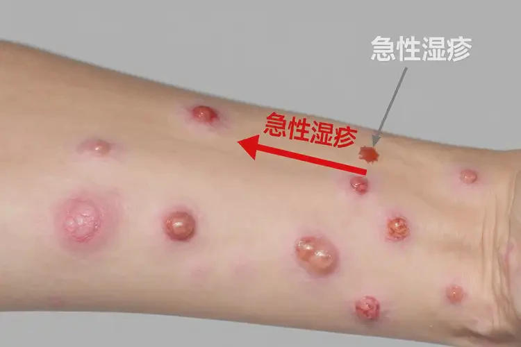 男人大腿上起濕疹不管它會自己好嗎(圖4)