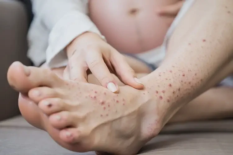 孕婦腳上經(jīng)常起濕疹能夠徹底治愈嗎(圖4)