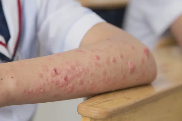 中學(xué)生手臂容易起濕疹不管它會(huì)自己好嗎(圖4)