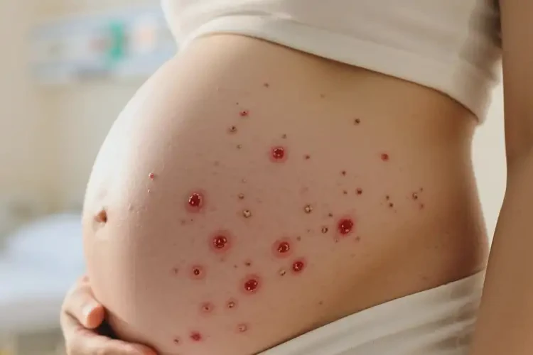孕妇肚子上经常长湿疹可不可以彻底自愈(图4)