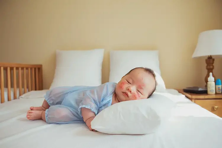 寶寶四肢出濕疹不管它會(huì)自己好嗎(圖1)