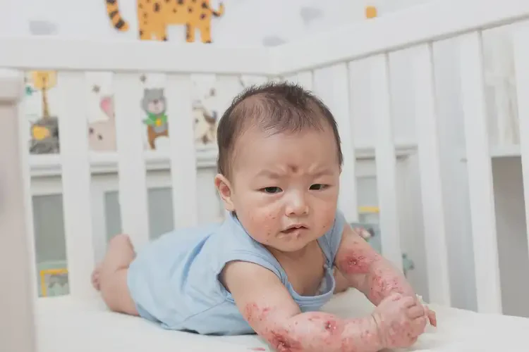 嬰幼兒手臂上長濕疹不管它會自己好嗎(圖4)