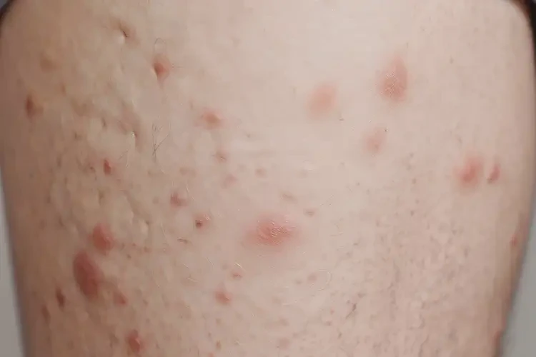 男生大腿起濕疹能靠自己自愈嗎(圖4)